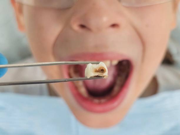 Best Emergency Tooth Extraction in Landover Hills, MD